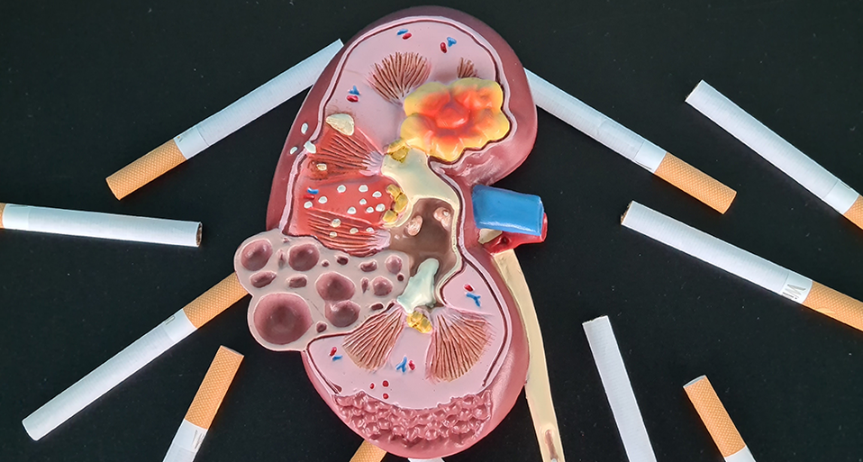 Smoking and Kidney Disease: See the Impact on Spending